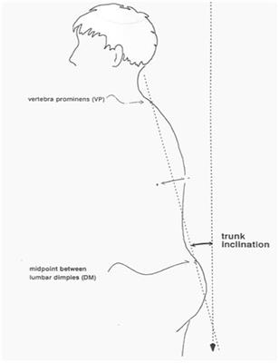 The Relationship Between the Shape of the Spine and the Width of Linea Alba in Children Aged 6–9 Years. Case-Control Study